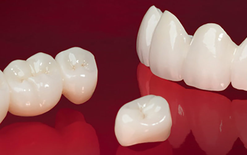 Zirconia and Porcelain Dental Crowns Which one to choose?