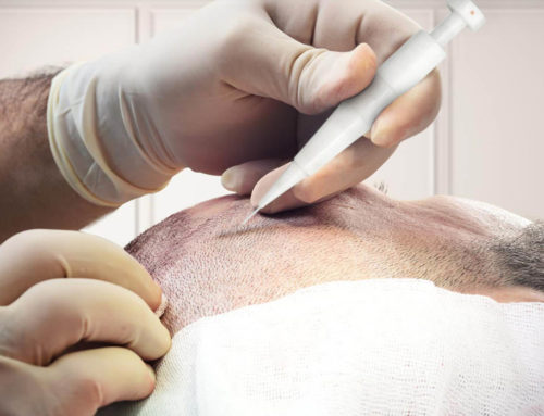 Choi Implanter Pen in Hair Transplant – Full guide