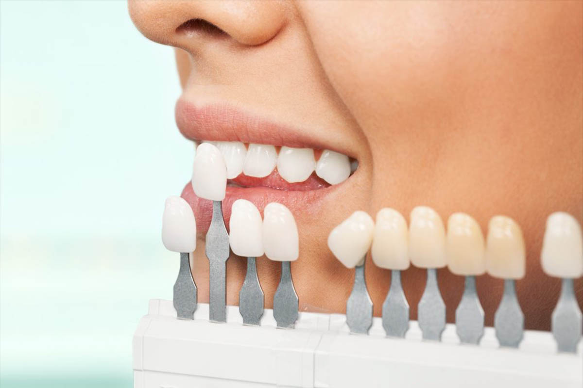 Emax Veneers in Turkey - What you need to know - IstanBest Clinic