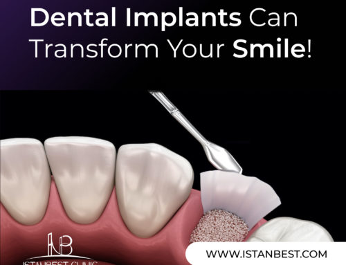 Treatments to Support Dental Implants:Sinus Lift, Bone Grafting, and Membrane