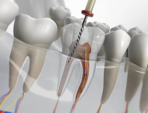 Root Canal Therapy – Saving one Tooth at a Time