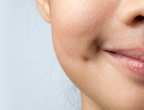Dimpleplasty: Risks and Rewards in Pursuit of Cheek Dimples